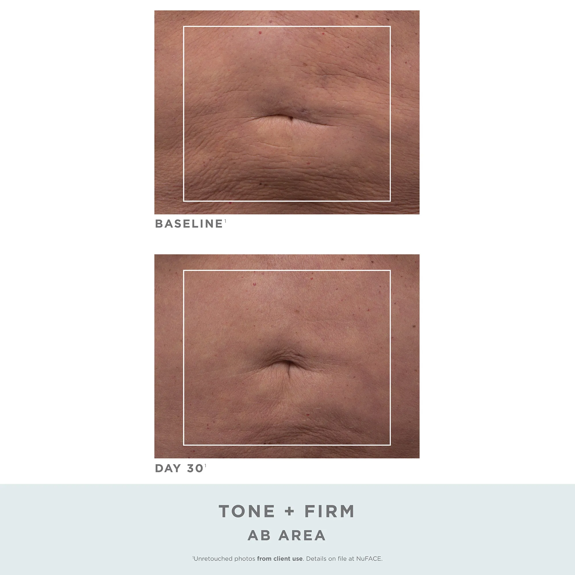 Nuface Nubody Toning And Firming Kit